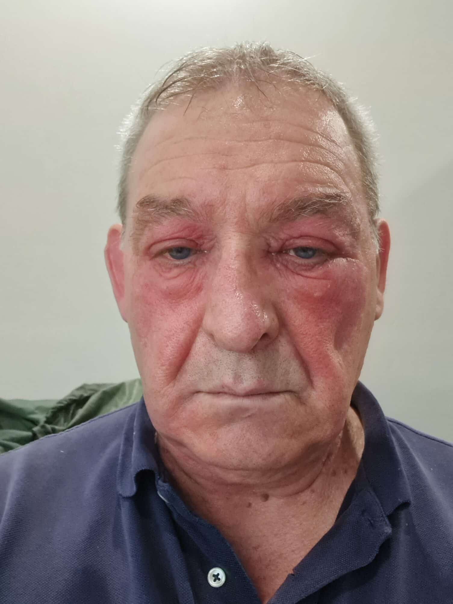 Picture of man in blue shirt showing swollen face after topical steroid cream withdrawal