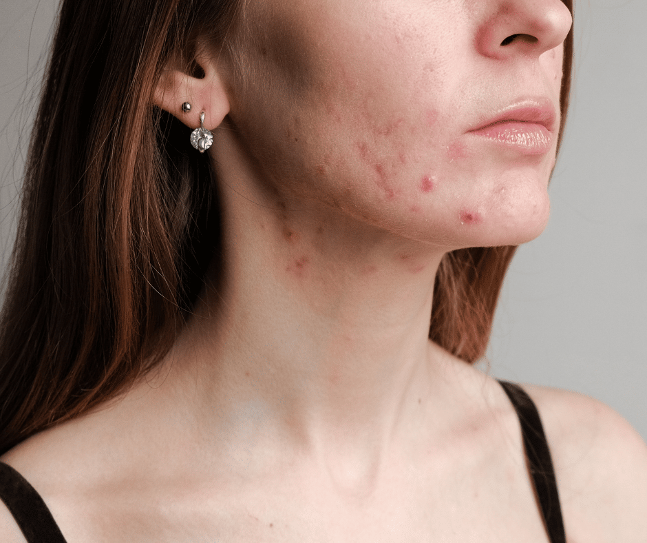 Woman with Acne pimples and brown hair 