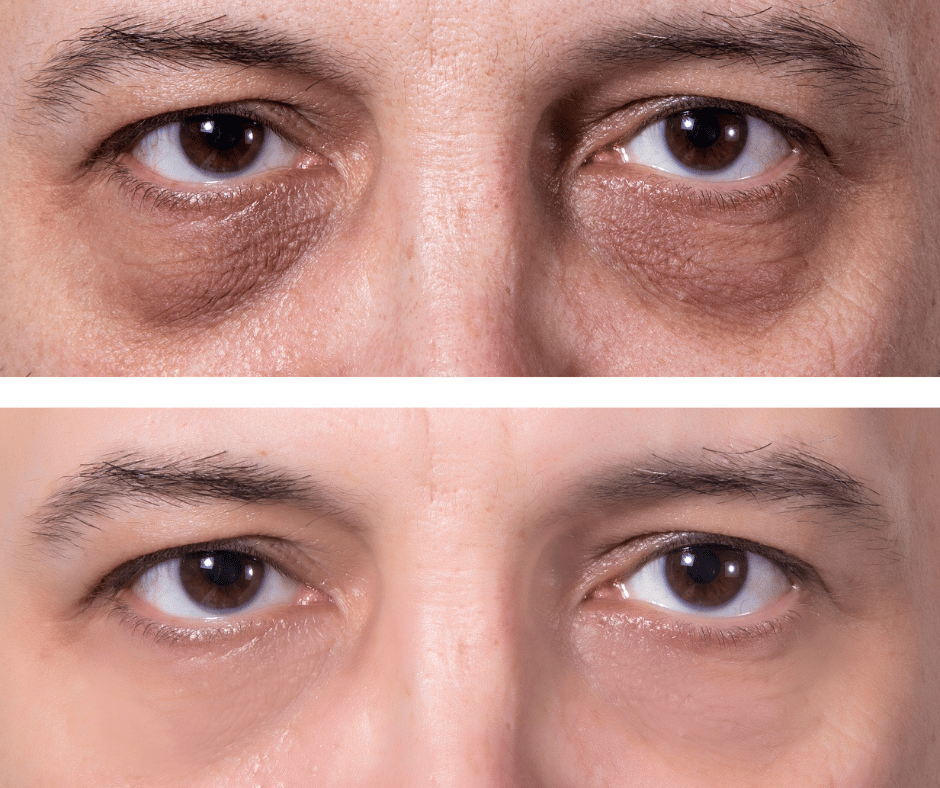 Comparison picture of a man before and after his treatment with dark circles around the eyes