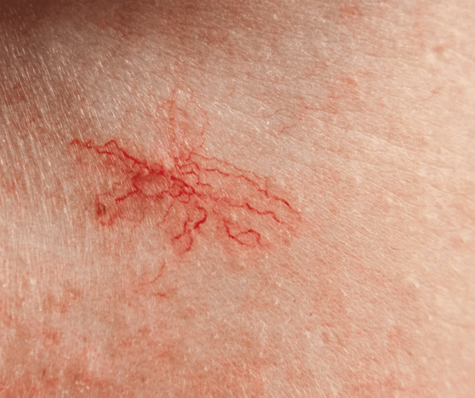 Picture of broken capillaries on the skin and visible veins