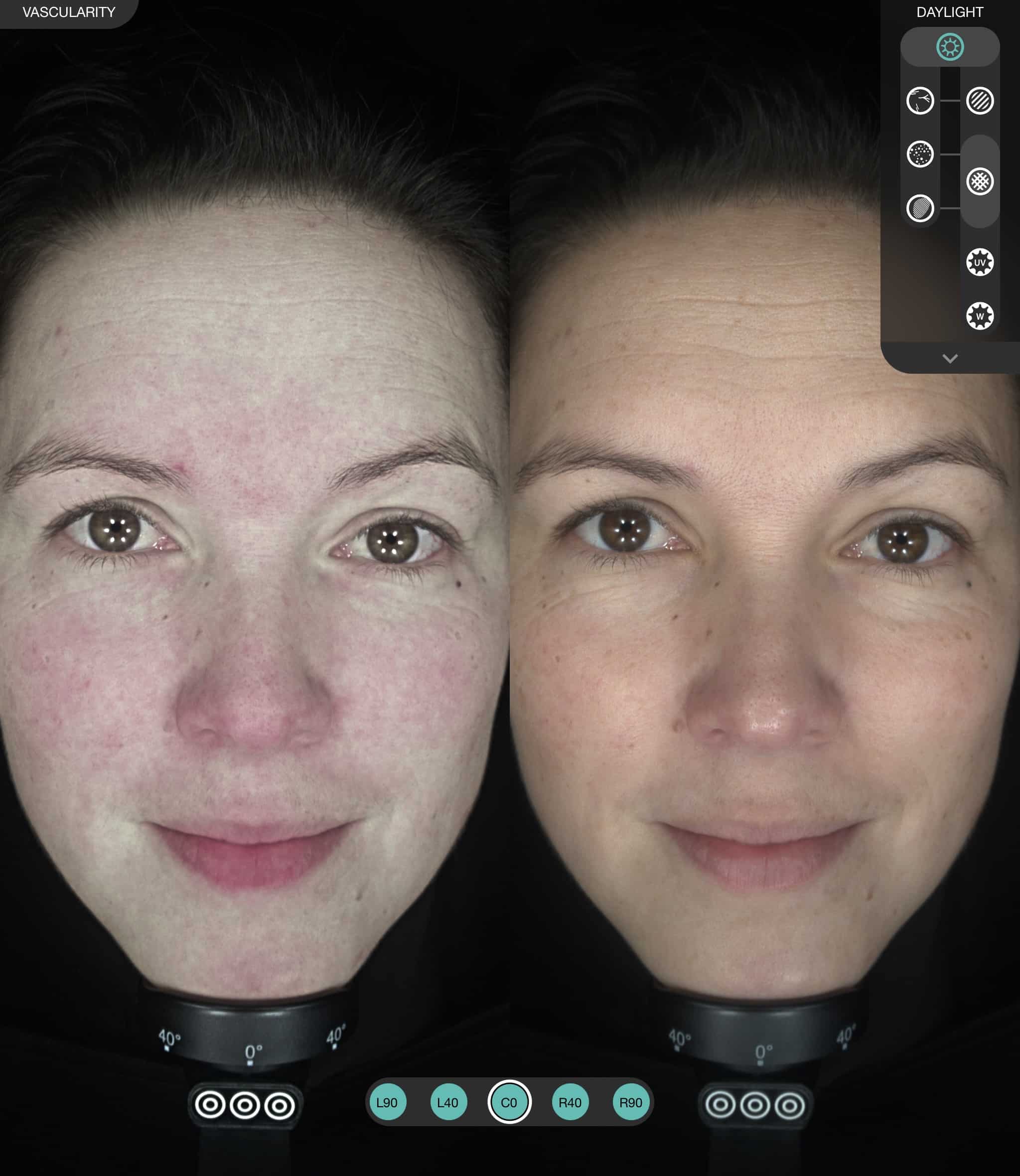 IMage of woman under two different light sources and how this shows rosacea and pigmentation