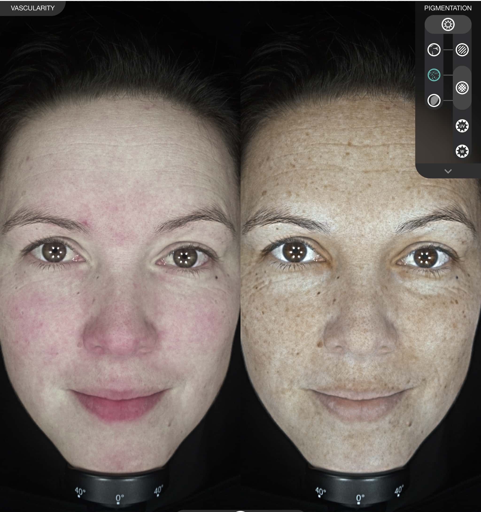 Image showing the same woman under different light and how rosacea affects the skin