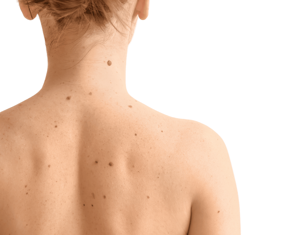 women facing away with moles on her back