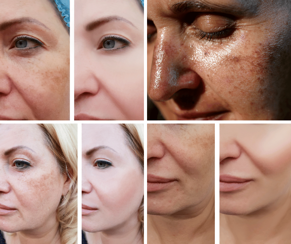 Multiple pictures / collage of women with pigmented skin and with pigmentation concerns