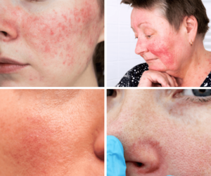 Illustrative examples only of rosacea