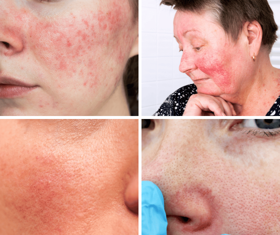 Pictures of 4 women with Rosacea skin conditions and visible veins