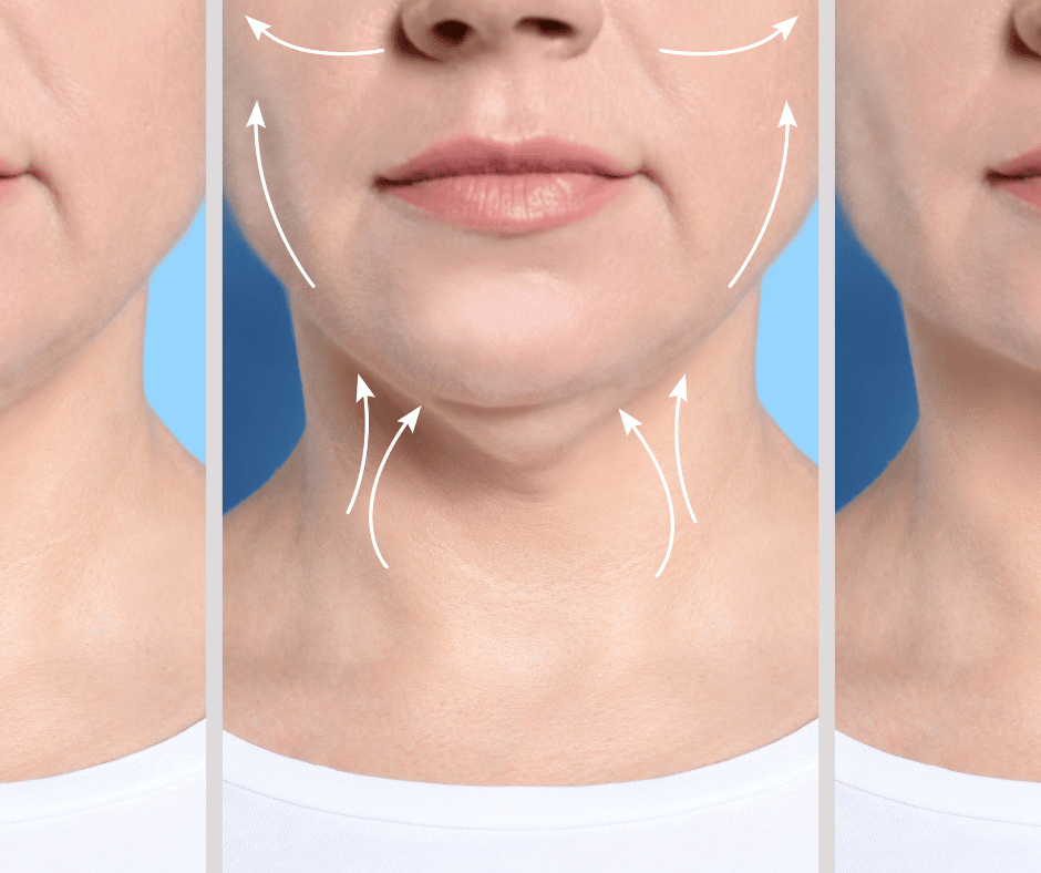 Woman with Jowls and how the right treatment can correct these