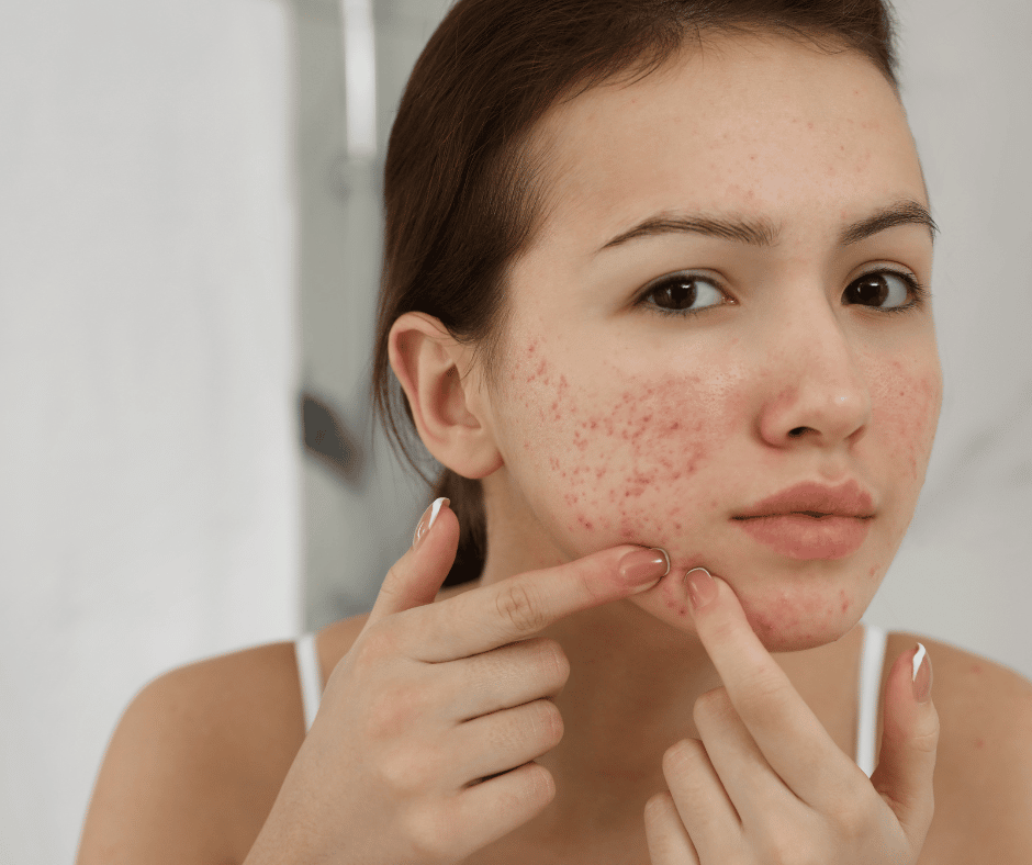 Picture of a young woman squeezing her acne spots and looking in a mirror