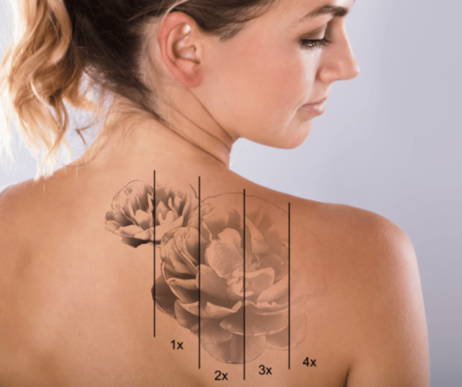 Picture of woman with tattoo on back and the effects of tattoo removal over 4 treatments